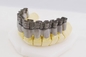 치과 의술을 위해 병을 고치는 20μM 고속도 크라운 브라켓 의학 3D 프린터 빛